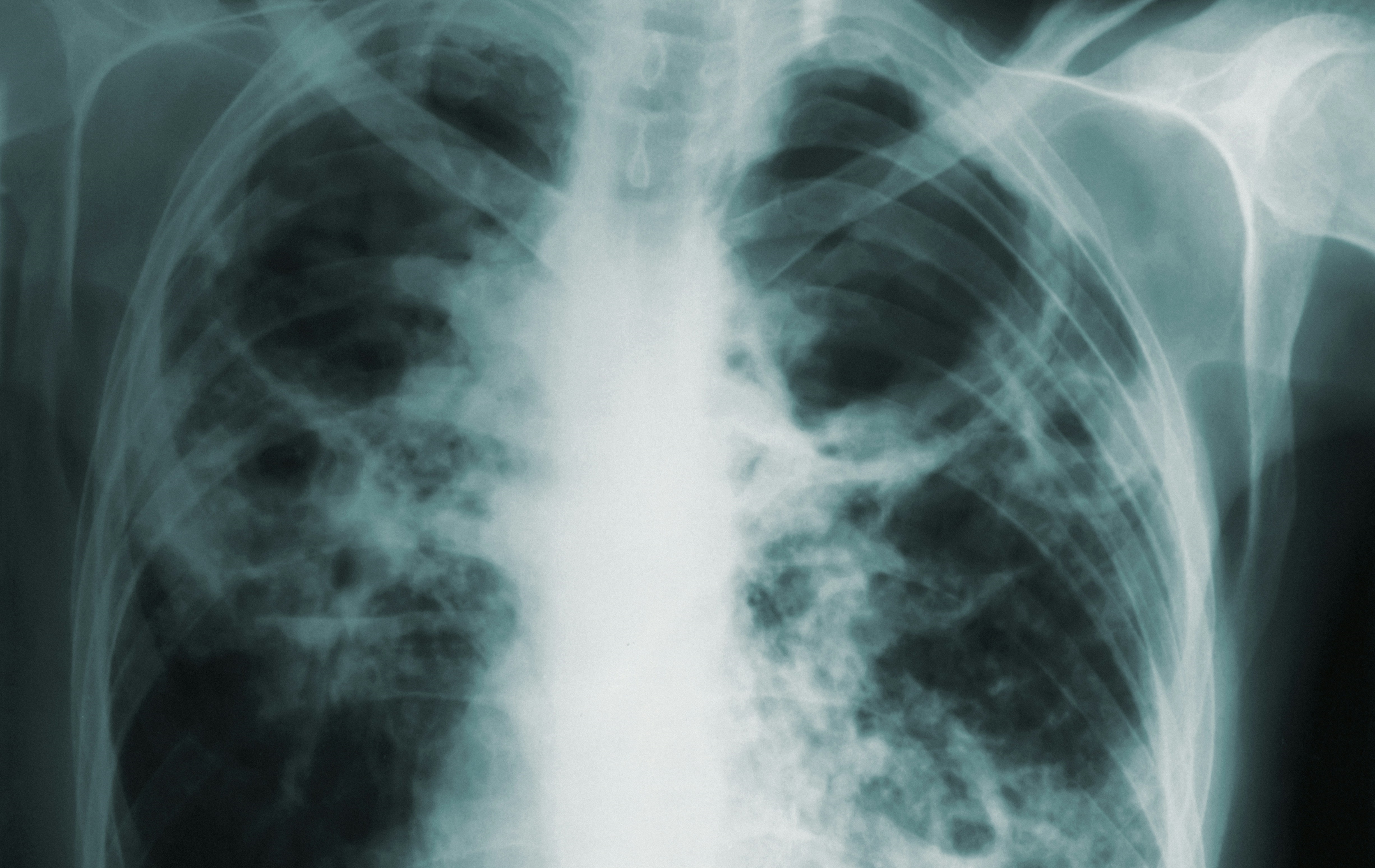 227 новых случаев туберкулёза выявлено в Марий Эл в 2023 году